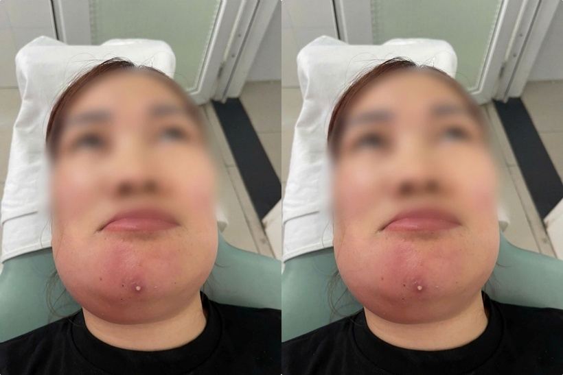 Người phụ nữ nhập viện sau 7 ngày tự nặn mụn tại nhà